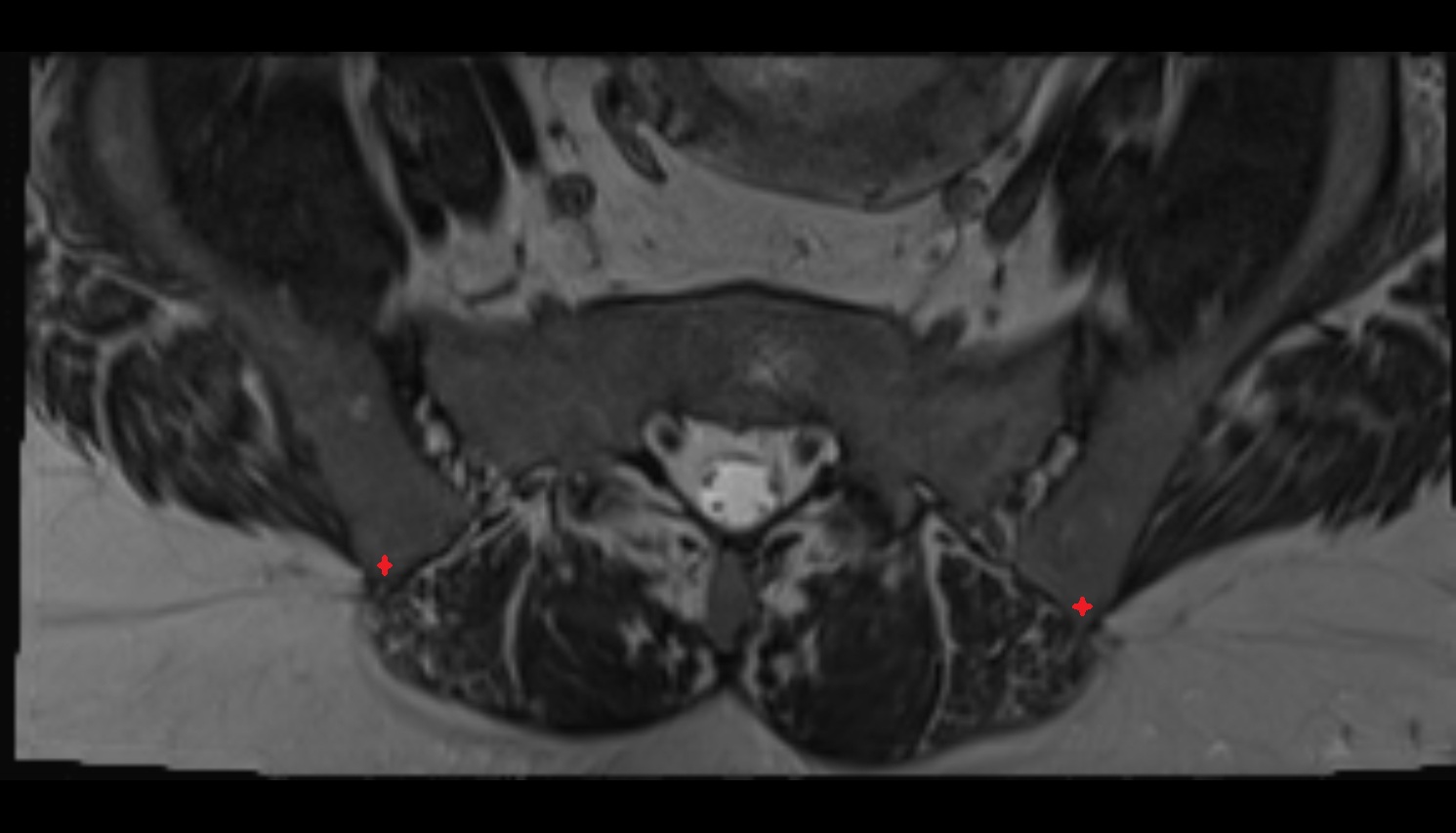 Posterior superior iliac spine  MRI axial anatomy  image -img-00000-00000