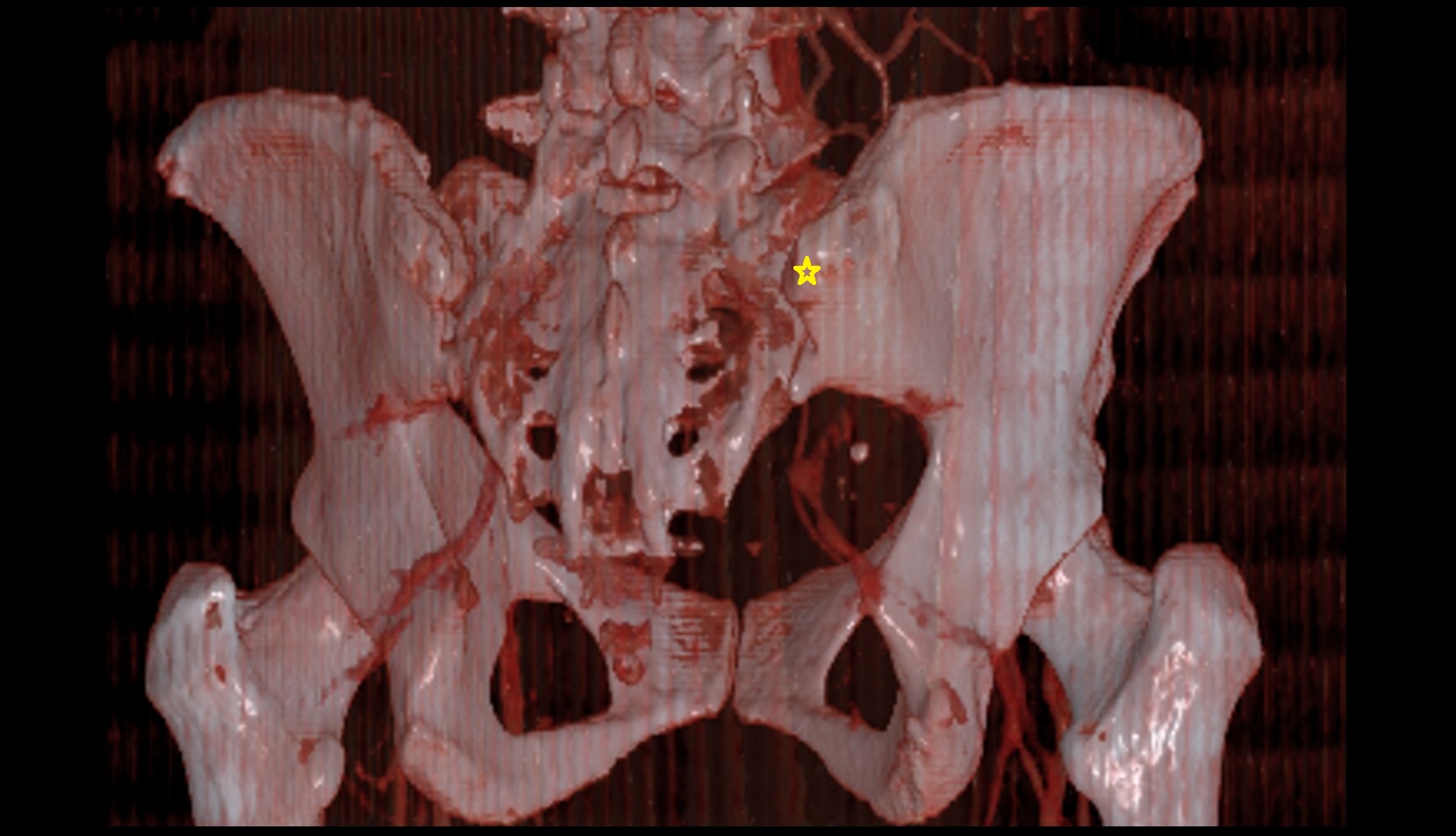 Posterior superior iliac spine ct 3d image