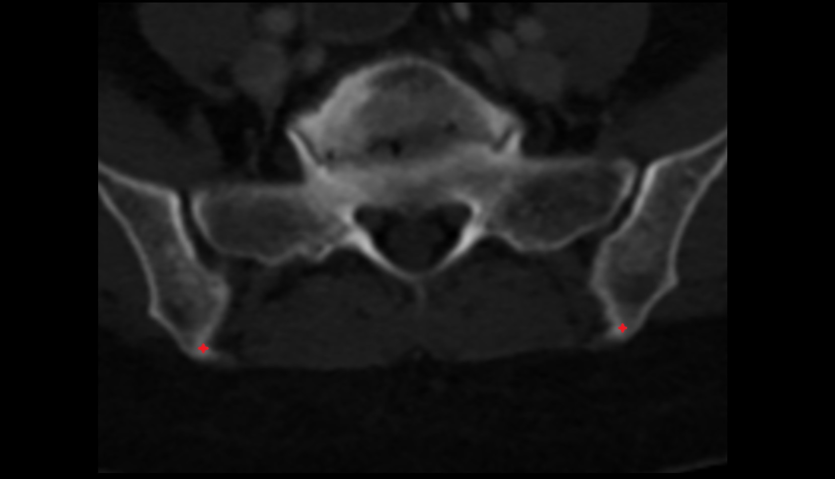 Posterior superior iliac spine ct axial image