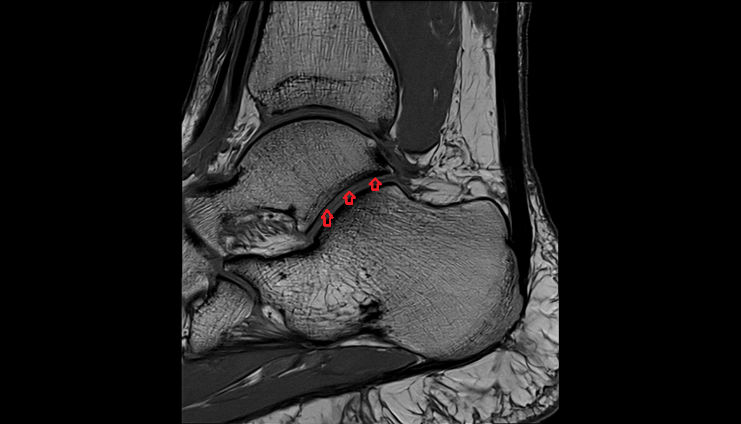 Posterior talar articular surface  mri  anatomy labelled image-img-00000-00000