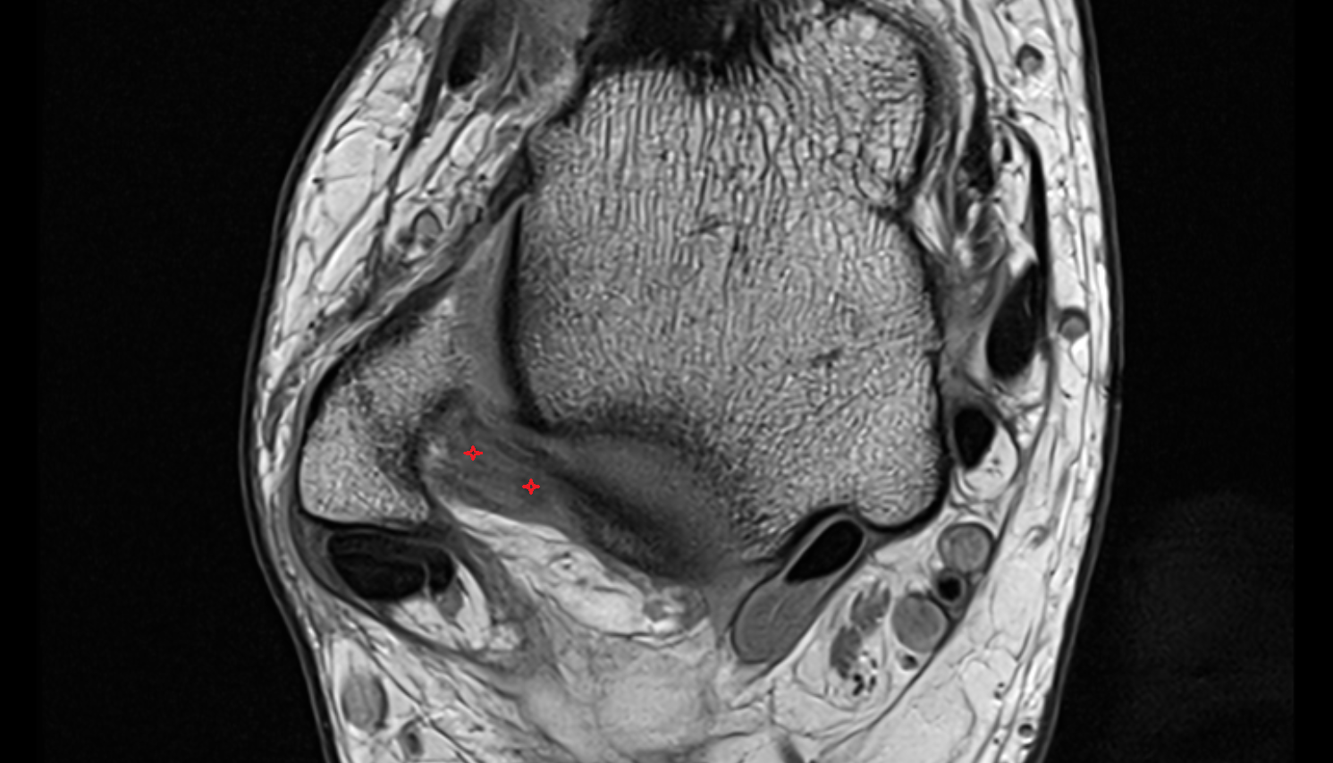 Posterior talofibular ligament axial cross sectional anatomy 3T MRI AI enhanced radiology image-img-00000-00000