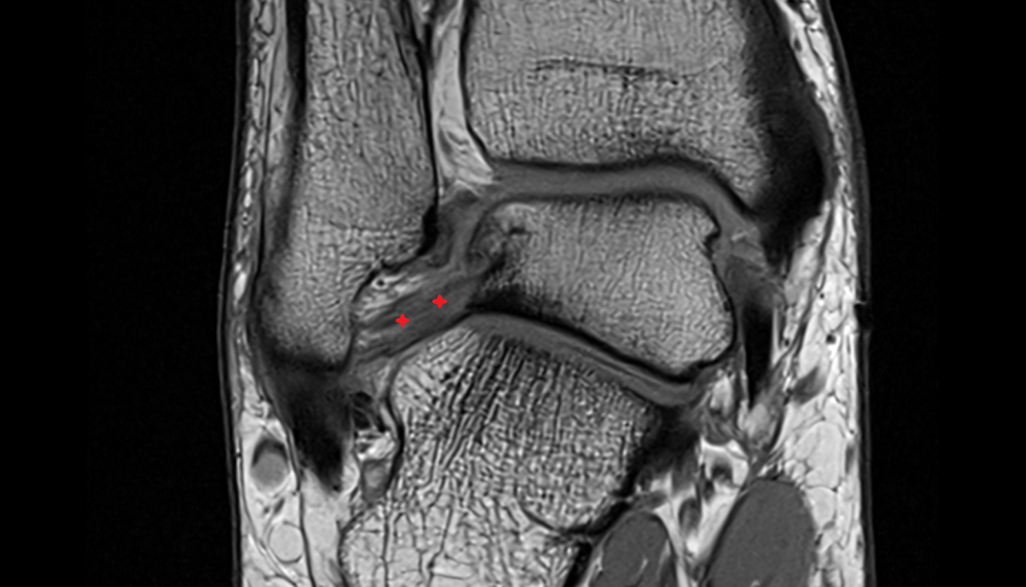 Posterior talofibular ligament coronal cross sectional anatomy 3T MRI AI enhanced radiology image-img-00000-00000