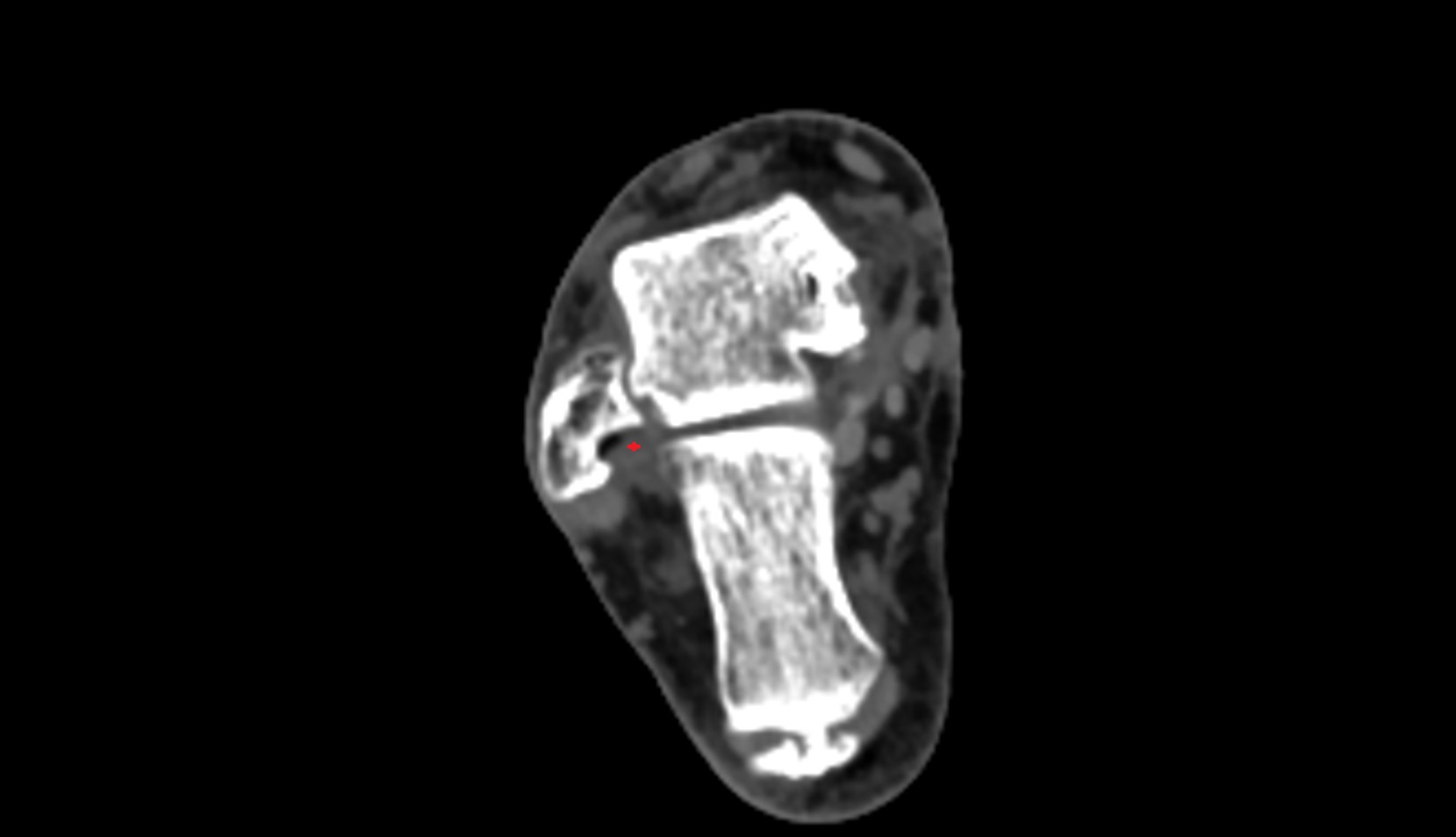 Posterior talofibular ligament ct axial