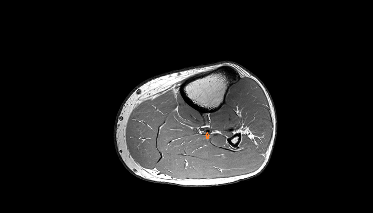 Posterior tibial artery axial  cross sectional anatomy 3T MRI AI enhanced radiology image-img-00000-00000