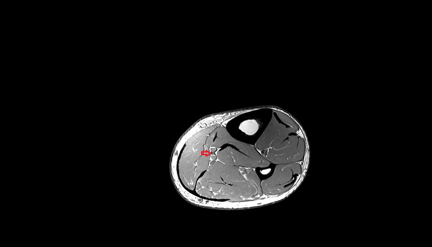 Posterior tibial artery axial  cross sectional anatomy 3T MRI AI enhanced radiology image-img-00000-00000_00001