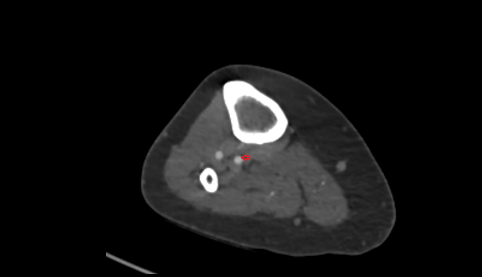 Posterior tibial artery axoal 0