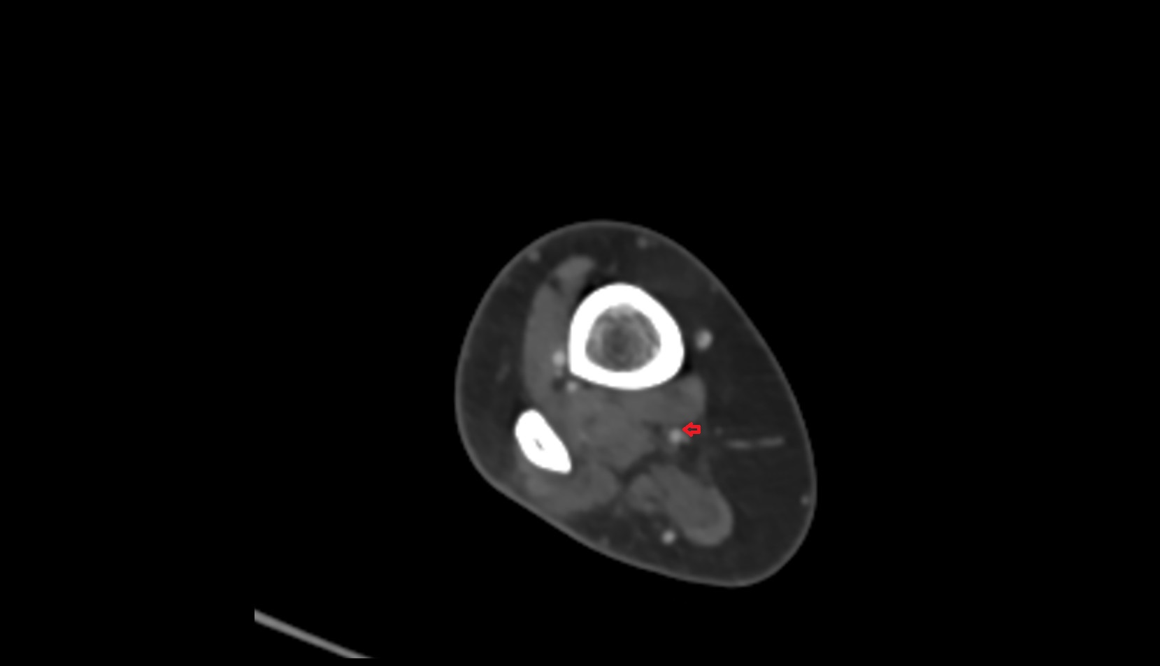 Posterior tibial artery ct axial 1