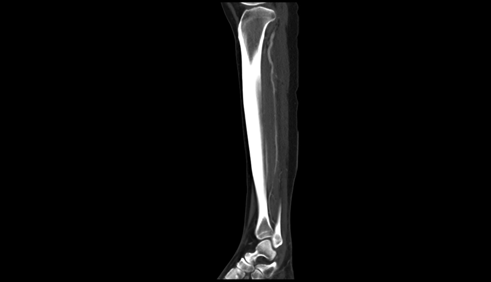 Posterior tibial artery ct sagittal image