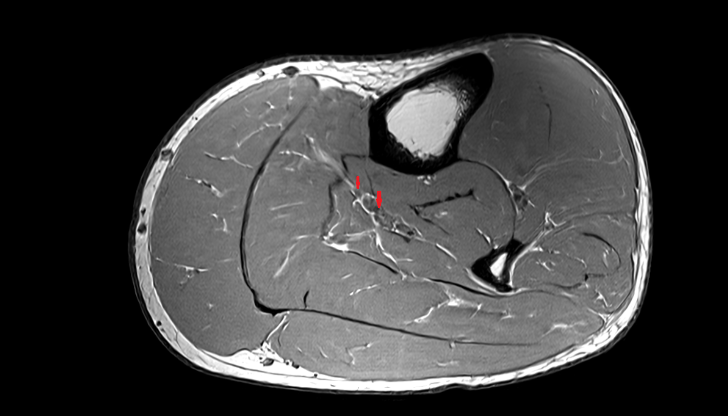 Posterior tibial veins  axial  cross sectional anatomy 3T MRI AI enhanced radiology image-img-00000-00000
