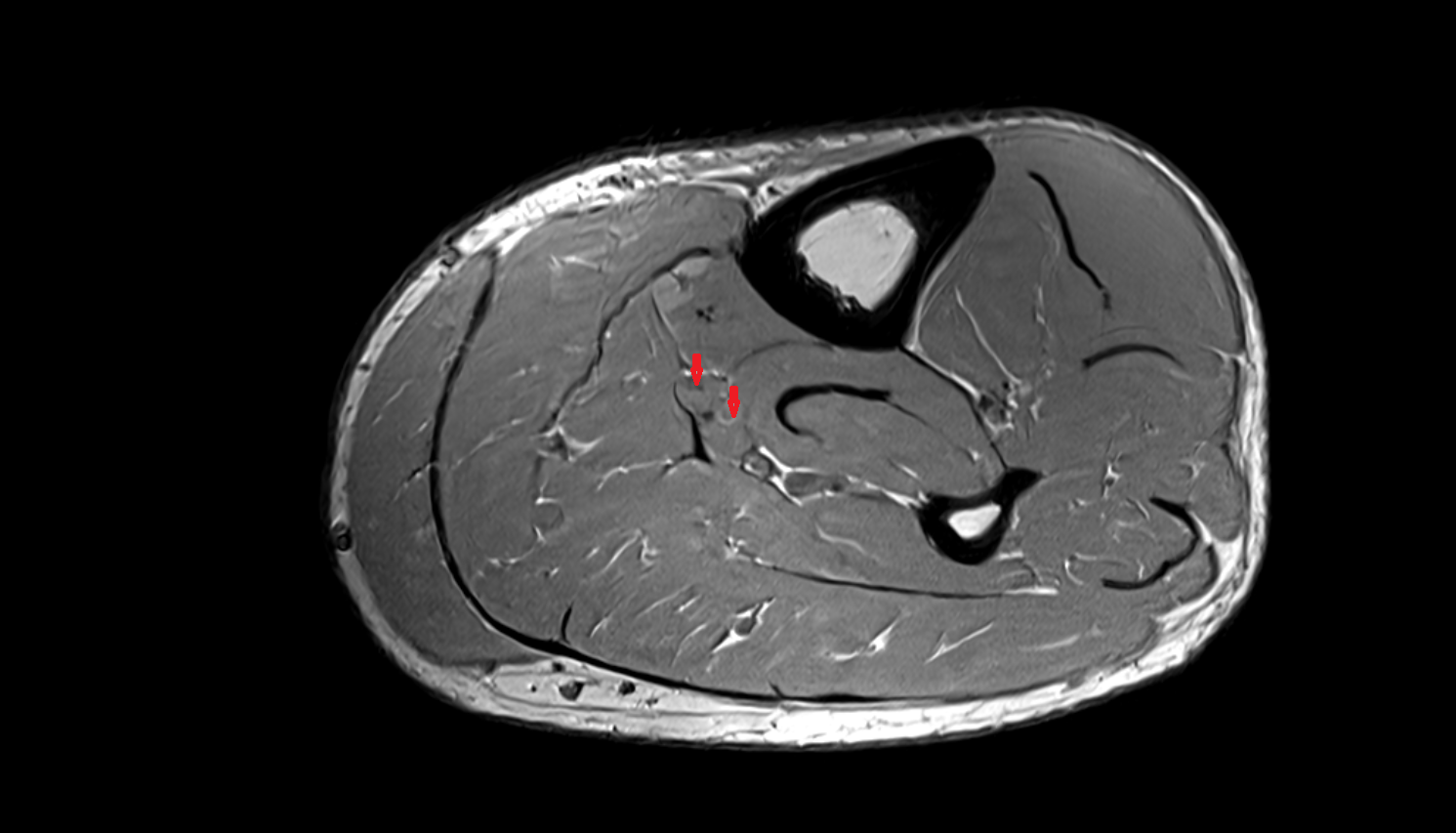 Posterior tibial veins  axial  cross sectional anatomy 3T MRI AI enhanced radiology image-img-00000-00000_00001