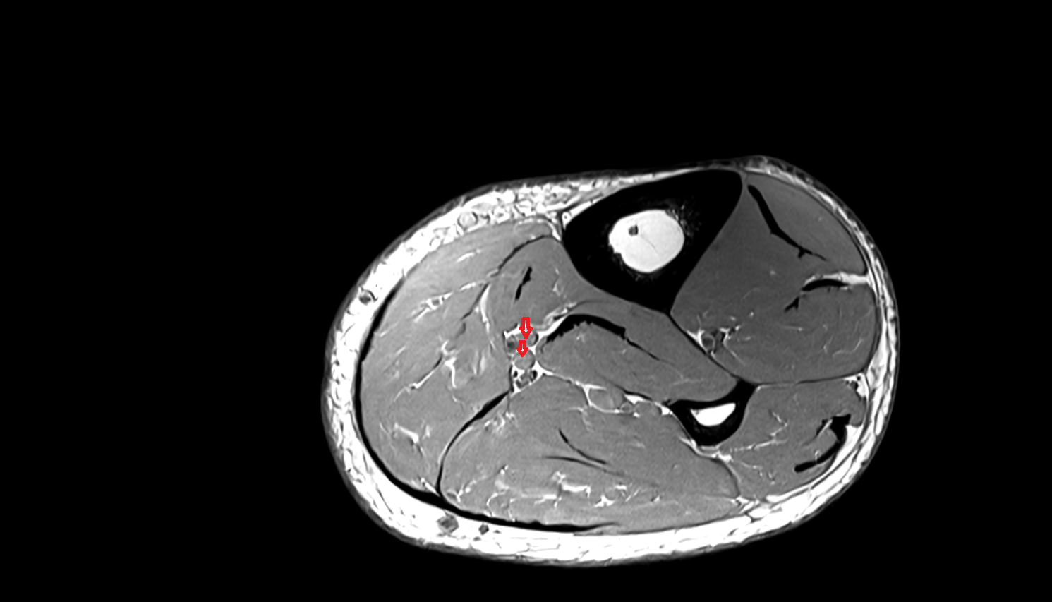 Posterior tibial veins  axial  cross sectional anatomy 3T MRI AI enhanced radiology image-img-00000-00000_00002