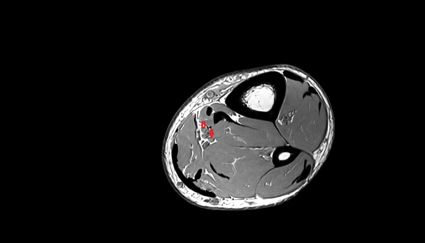 Posterior tibial veins  axial  cross sectional anatomy 3T MRI AI enhanced radiology image-img-00000-00000_00003