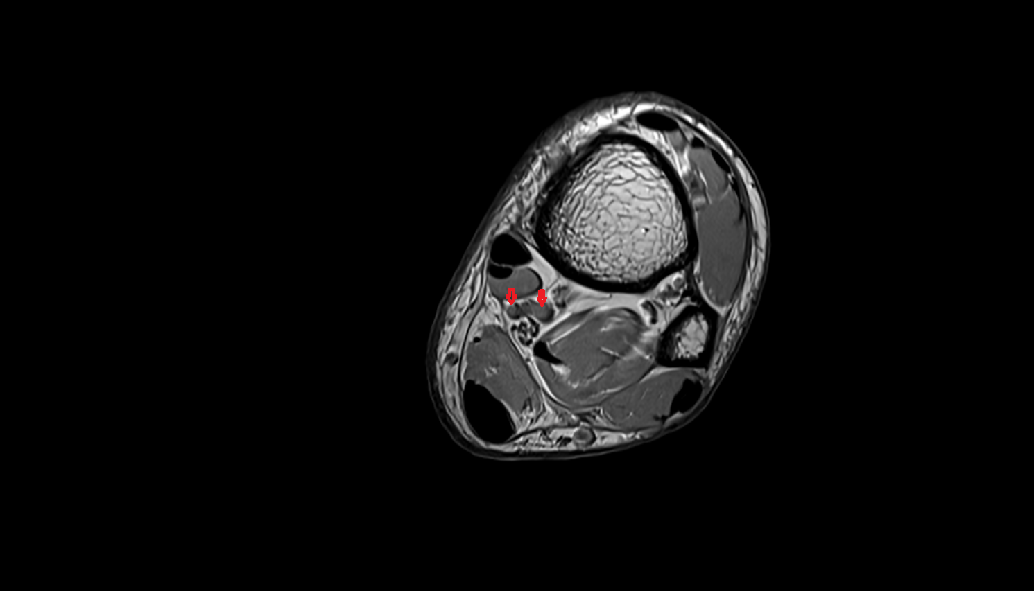 Posterior tibial veins  axial  cross sectional anatomy 3T MRI AI enhanced radiology image-img-00000-00000_00004