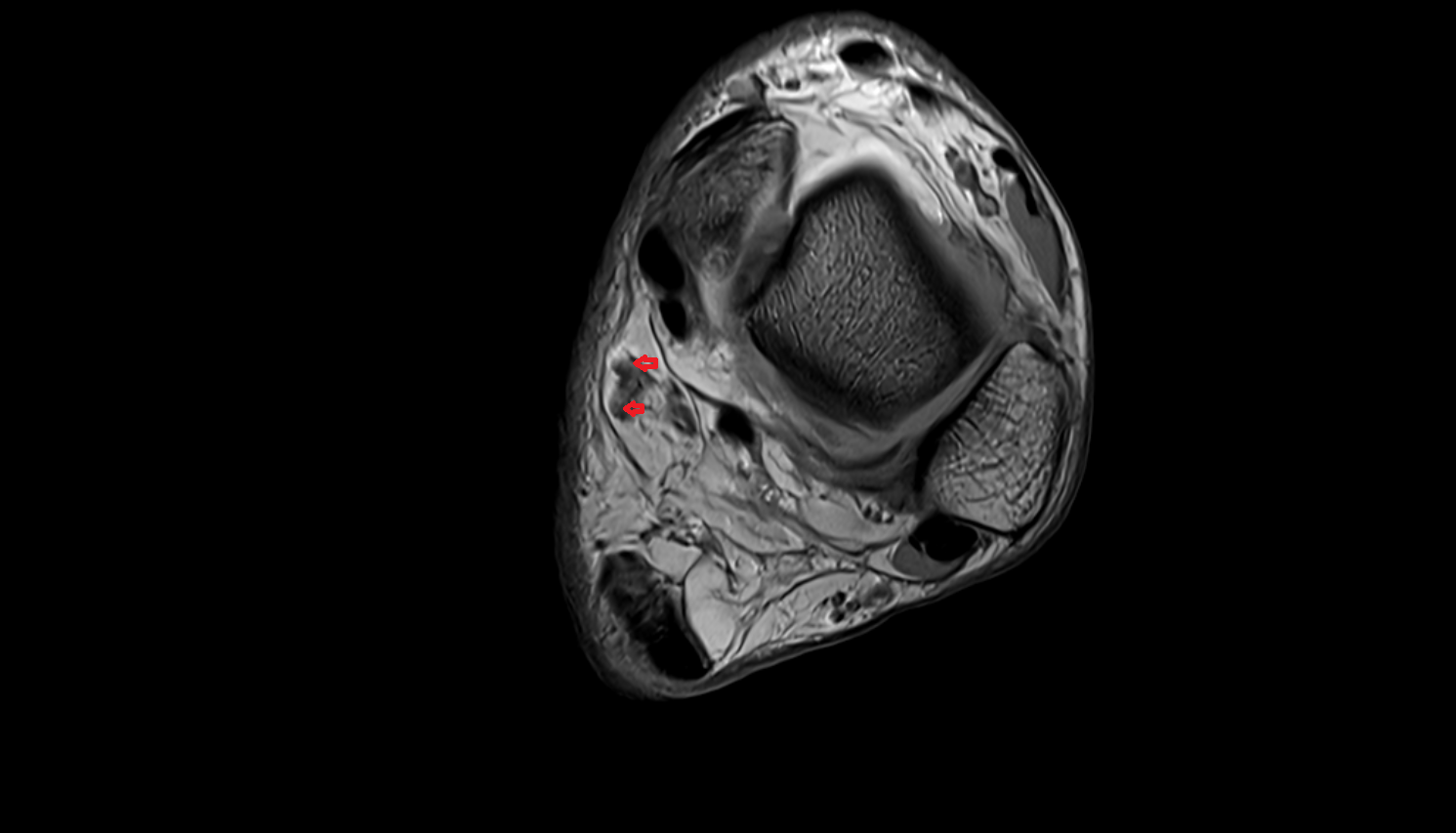 Posterior tibial veins  axial  cross sectional anatomy 3T MRI AI enhanced radiology image-img-00000-00000_00005
