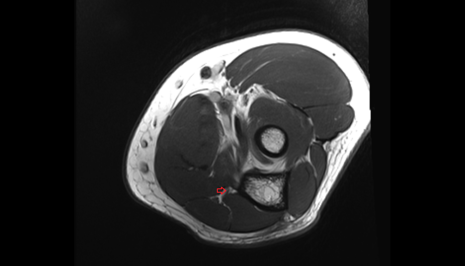Posterior ulnar recurrent artery axial cross sectional anatomy 3T MRI AI enhanced radiology image -img-00000-00000_00001
