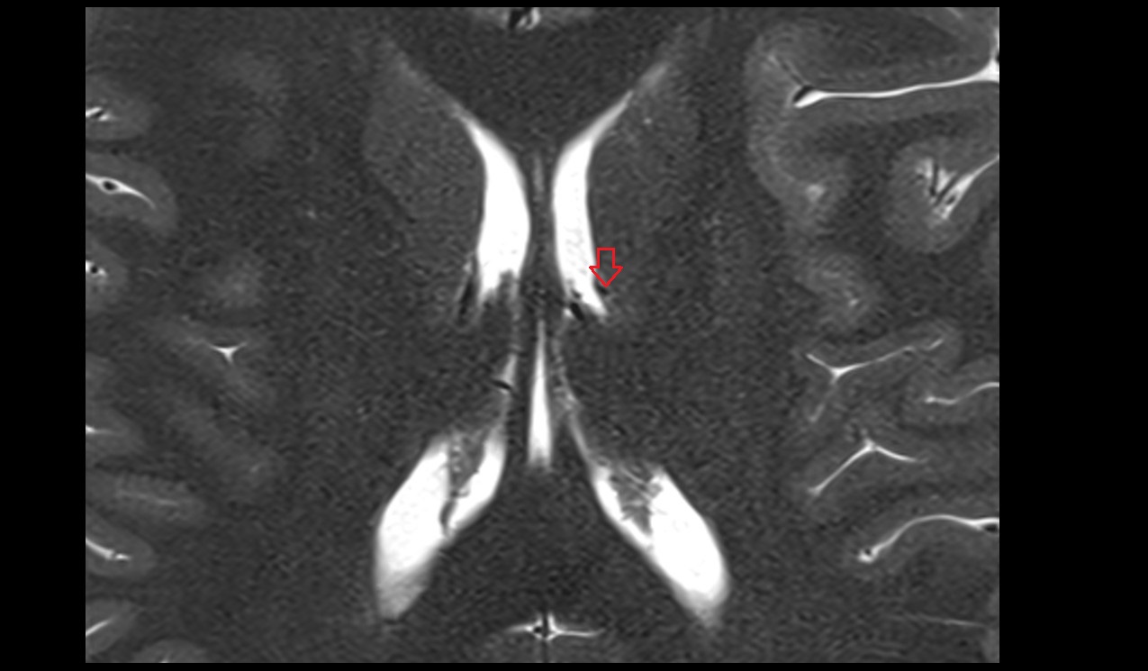 Posterior vein of caudate nucleus MRI 3T axial image