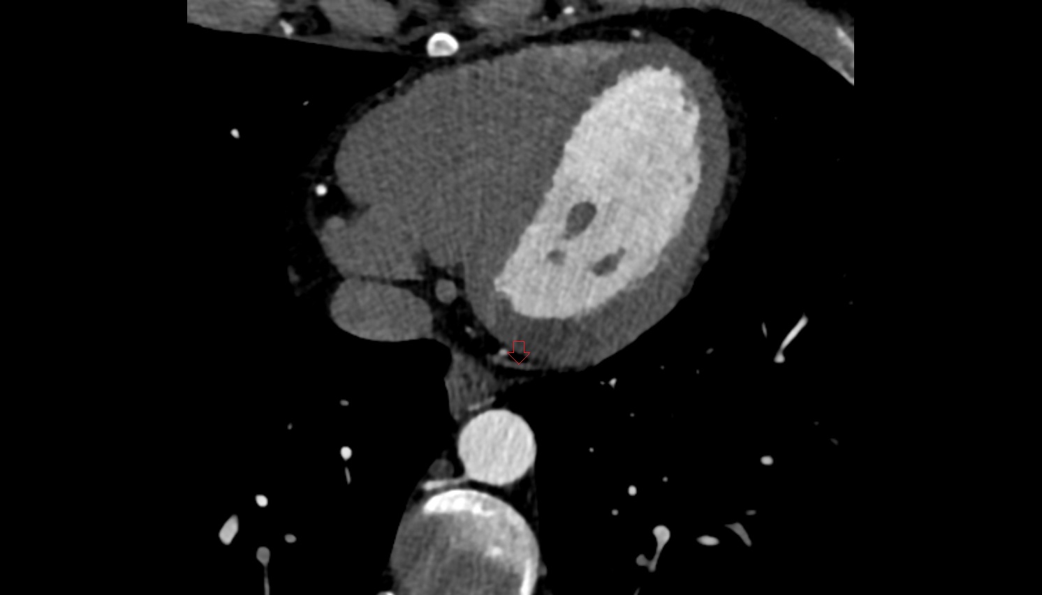 Posterior vein of left ventricle  CT  axial image -img-00000-00000