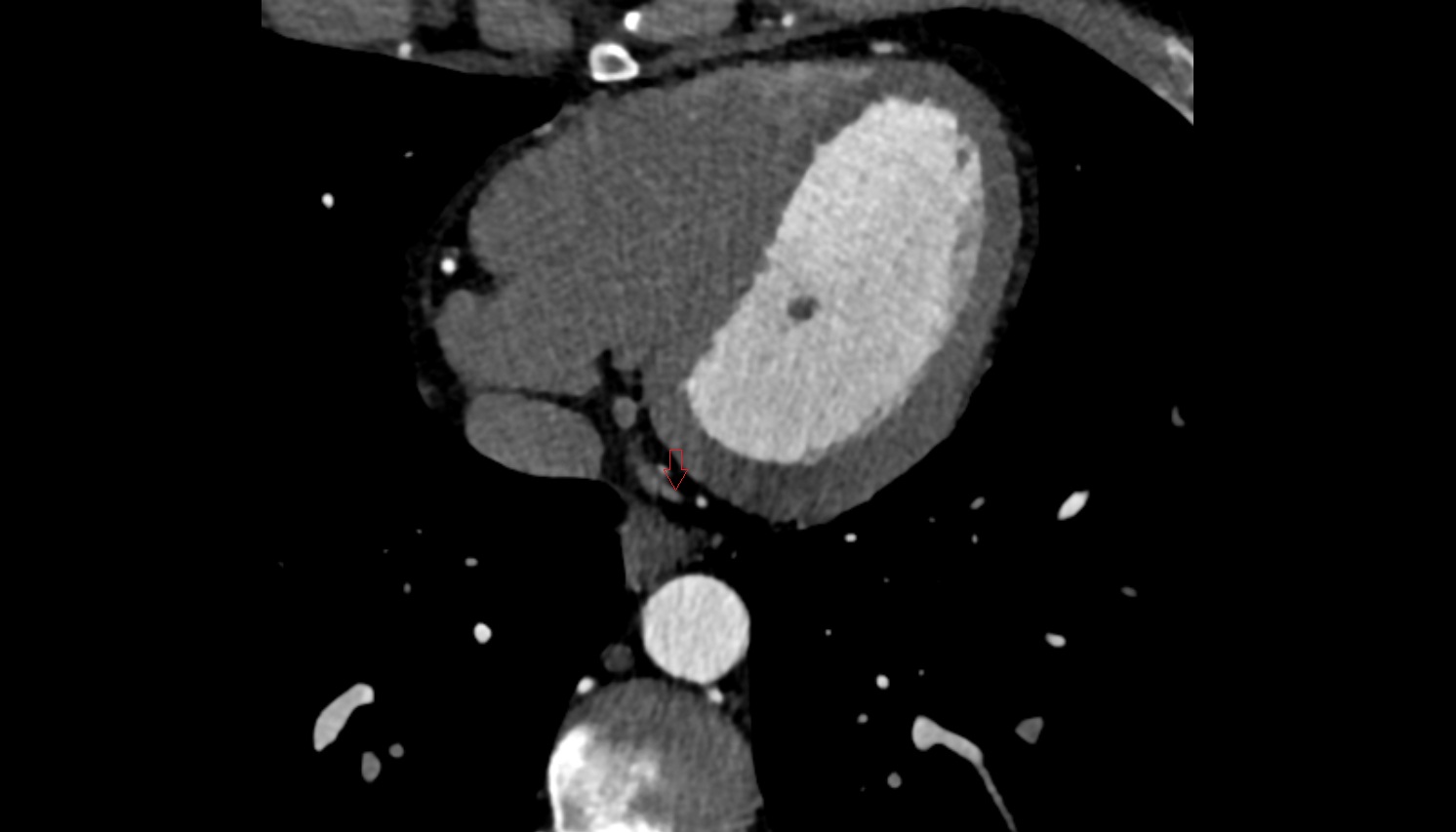 Posterior vein of left ventricle  CT  axial image -img-00000-00000_00001