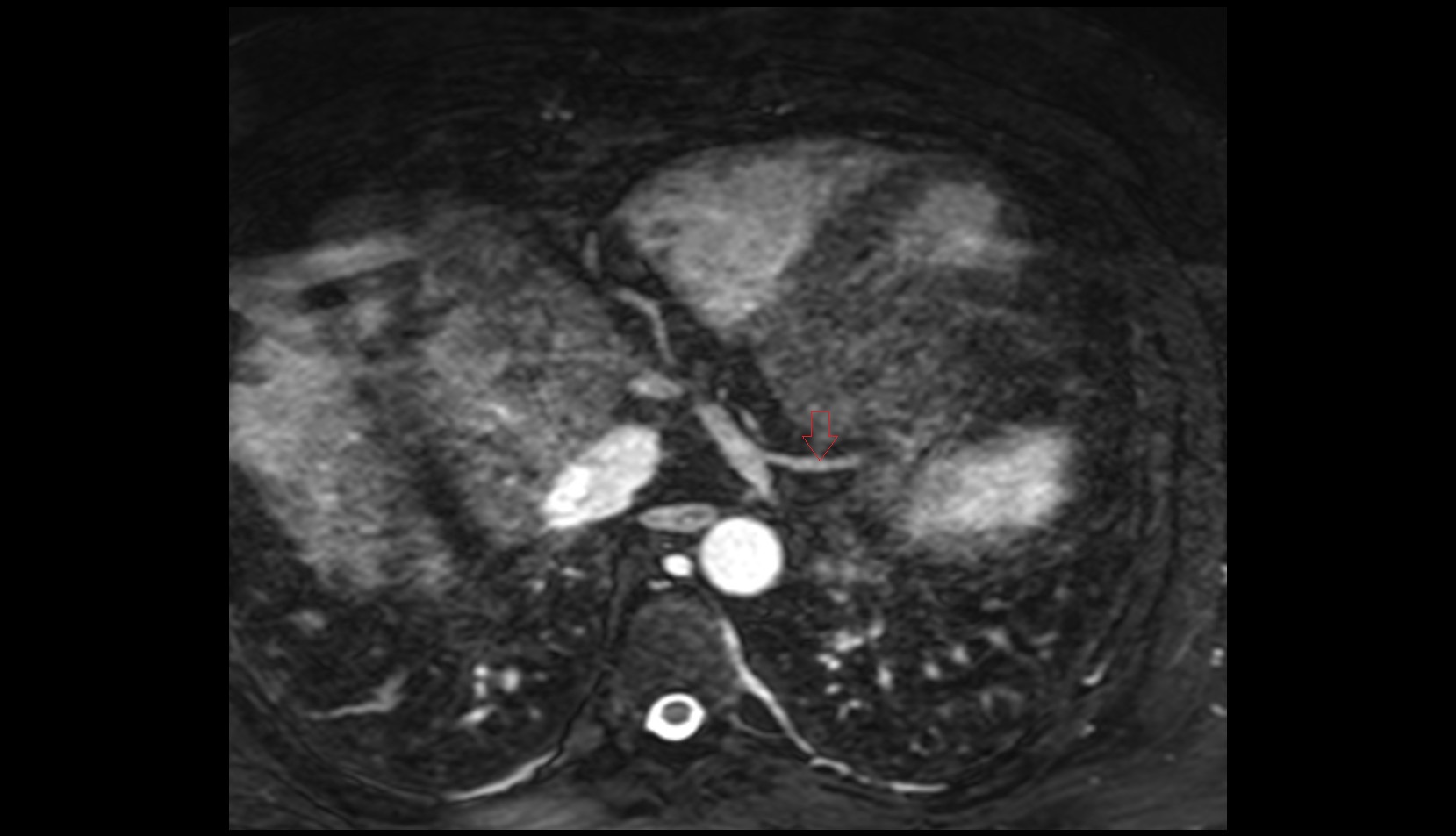 Posterior vein of left ventricle mri axial