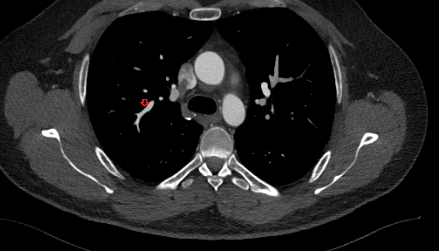 Posterior vein of right lung CT axial image -img-00000-00000