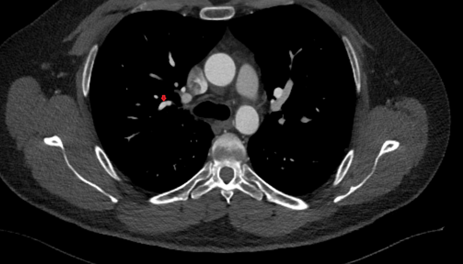 Posterior vein of right lung CT axial image -img-00000-00000_00001