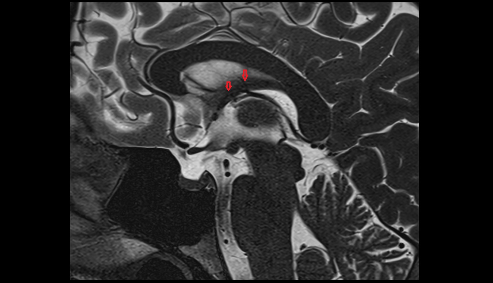 Posterior vein of septum pellucidum