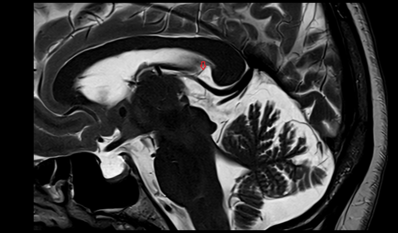 Posterior veins of septum pellucidum MRI 3T image