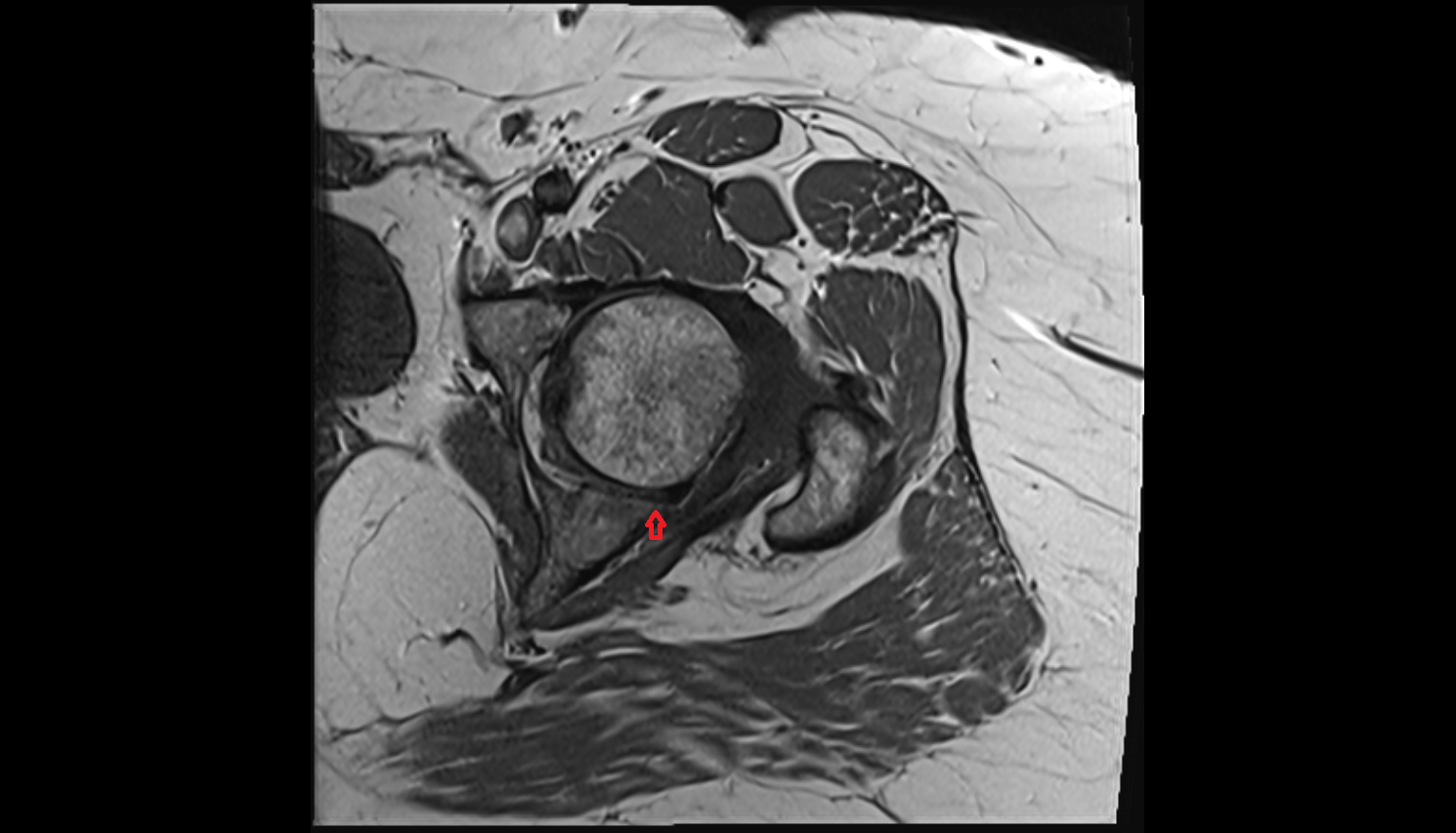 Posterior wall of acetabulum  MRI axial image-img-00000-00000