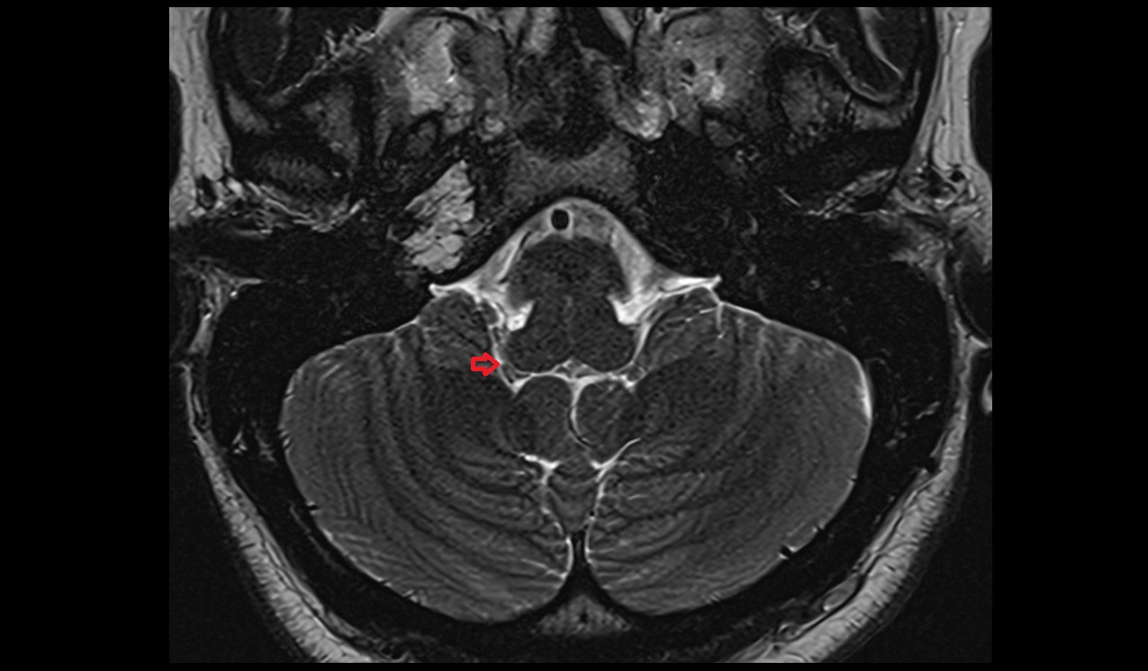Posterolateral fissure MRI 3T axial image