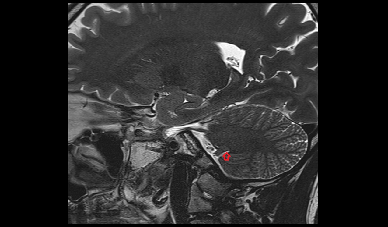 Posterolateral fissure MRI 3T sagittal image