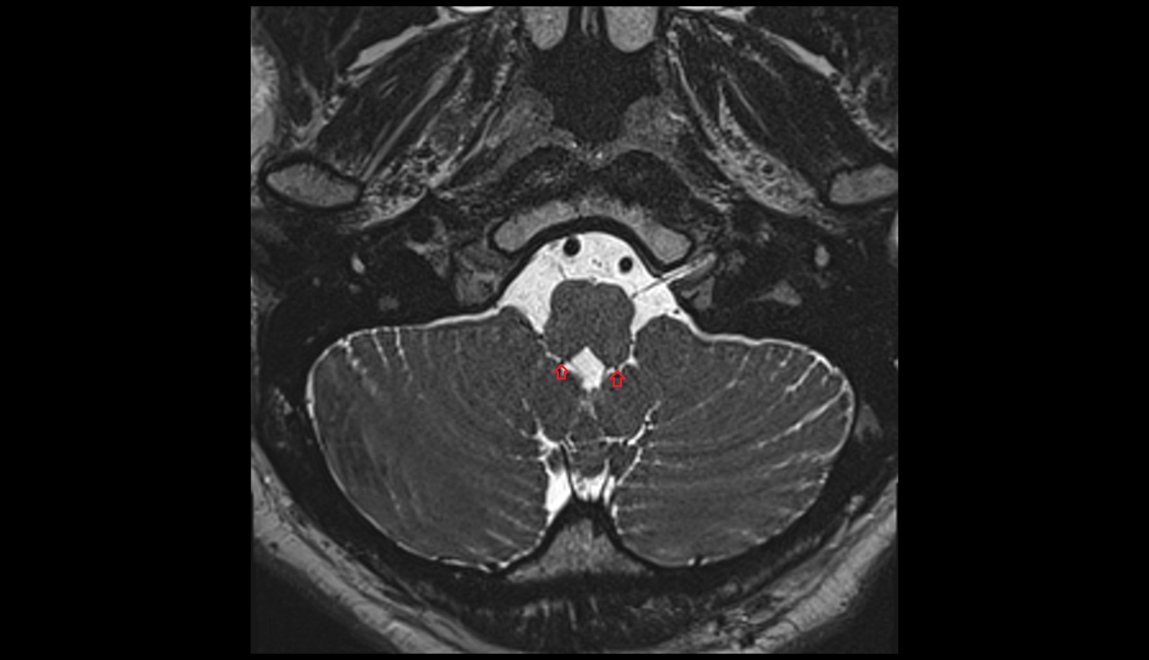 Posteromedian medullary vein MRI 3T image