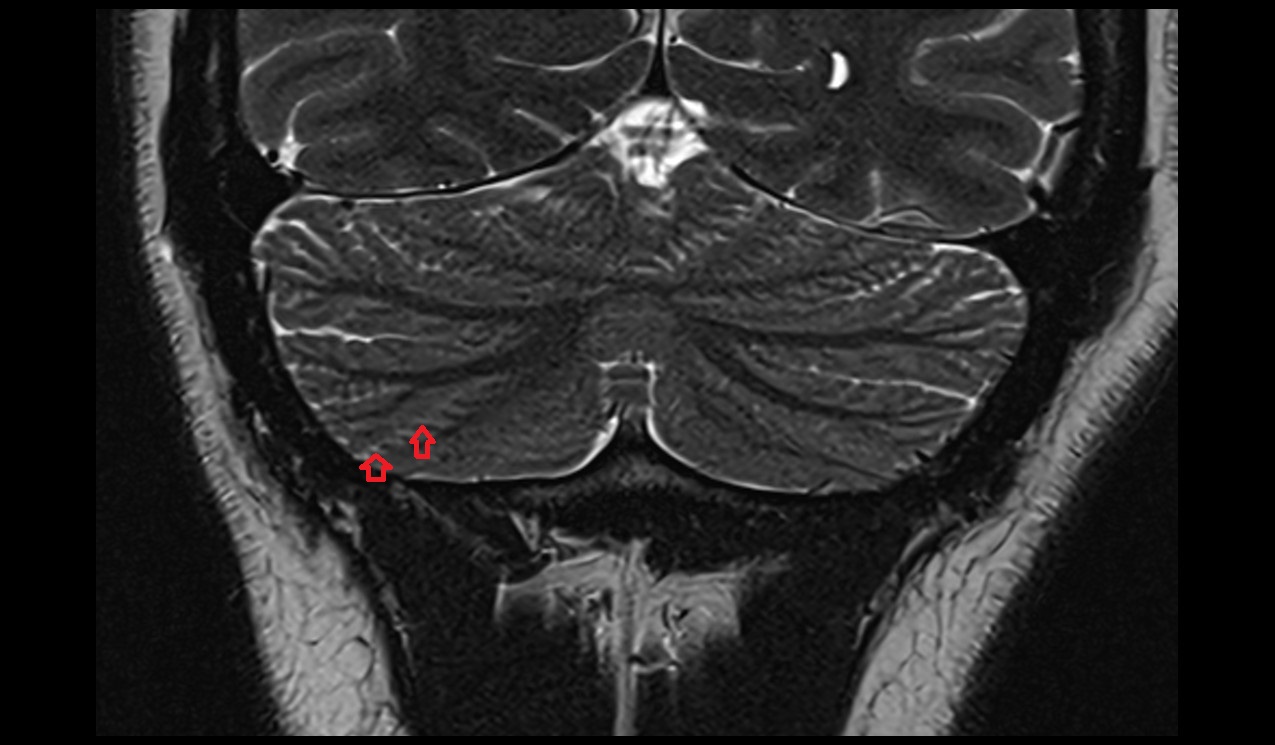 Prebiventral fissure MRI 3T coronal image