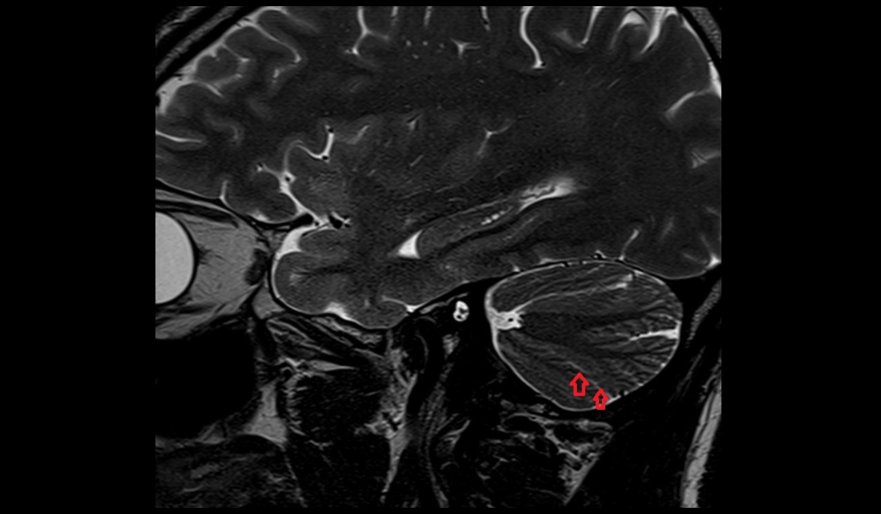 Prebiventral fissure MRI 3T sagittal image