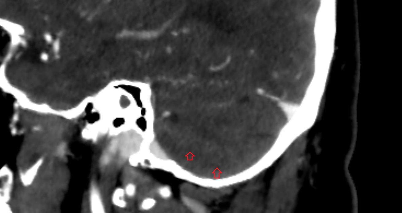 Prebiventral fissure of cerebellum  CT sag  anatomy image -img-00001-00001_00001