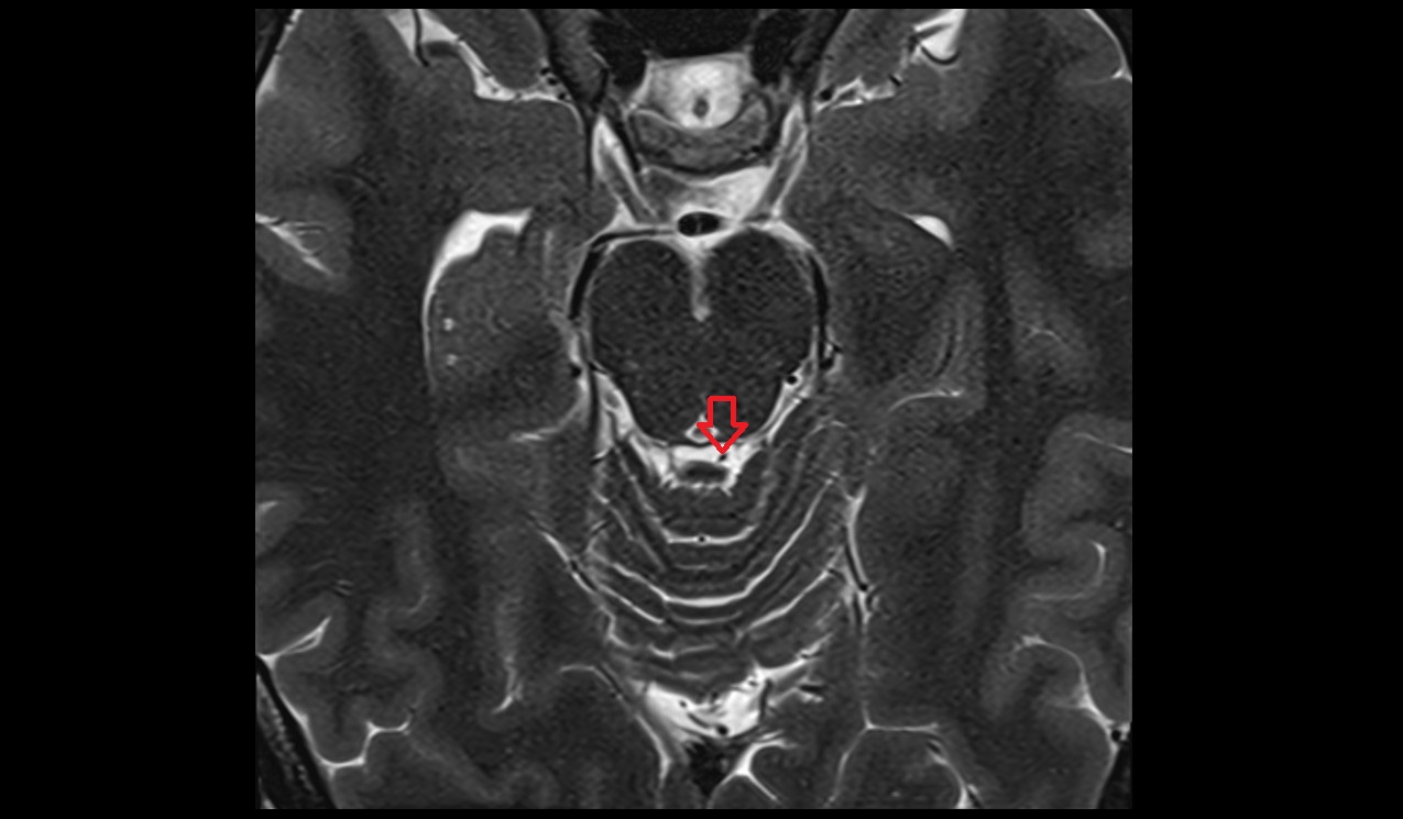 Precentral cerebellar vein MRI 3T axial image