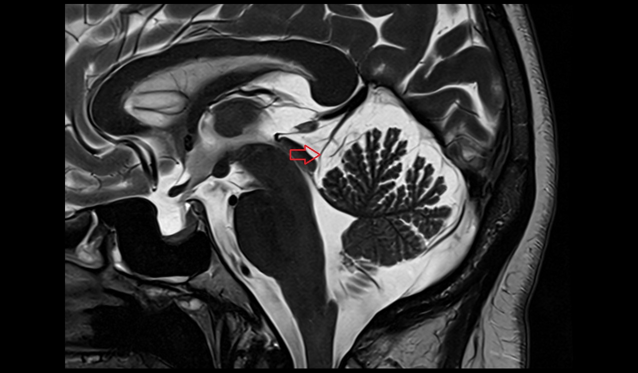 Precentral cerebellar vein MRI 3T sagittal image