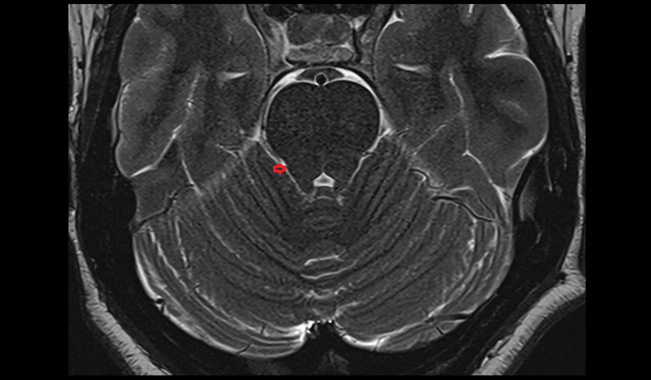 Precentral fissure MRI 3T axial image