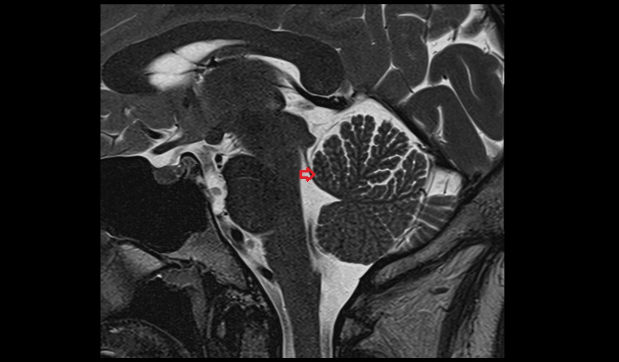 Precentral fissure MRI 3T sagittal image
