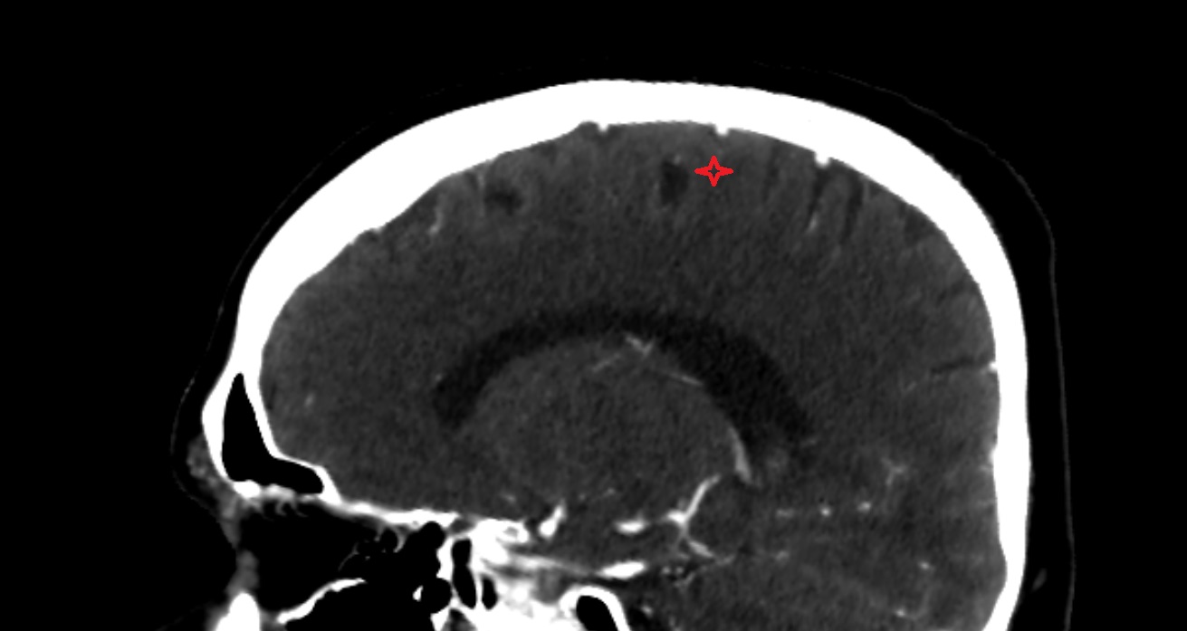 Precentral gyrus  CT sagittal  anatomy image -img-00001-00001