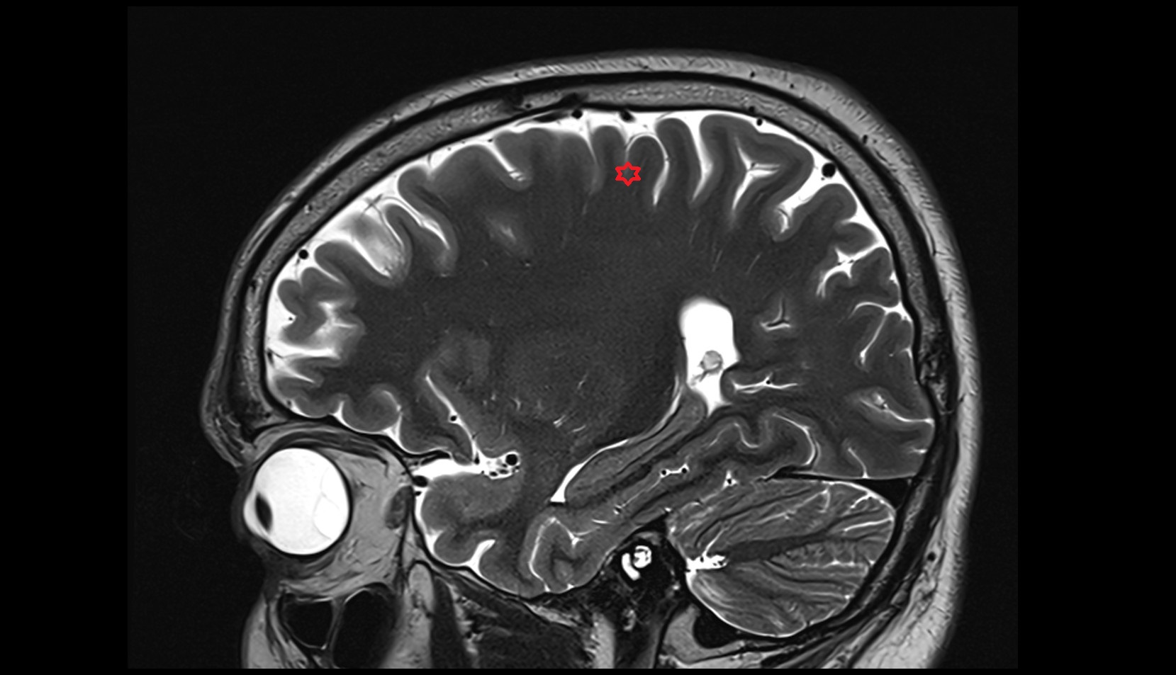 Precentral gyrus MRI 3T SAGITTAL IMAGE