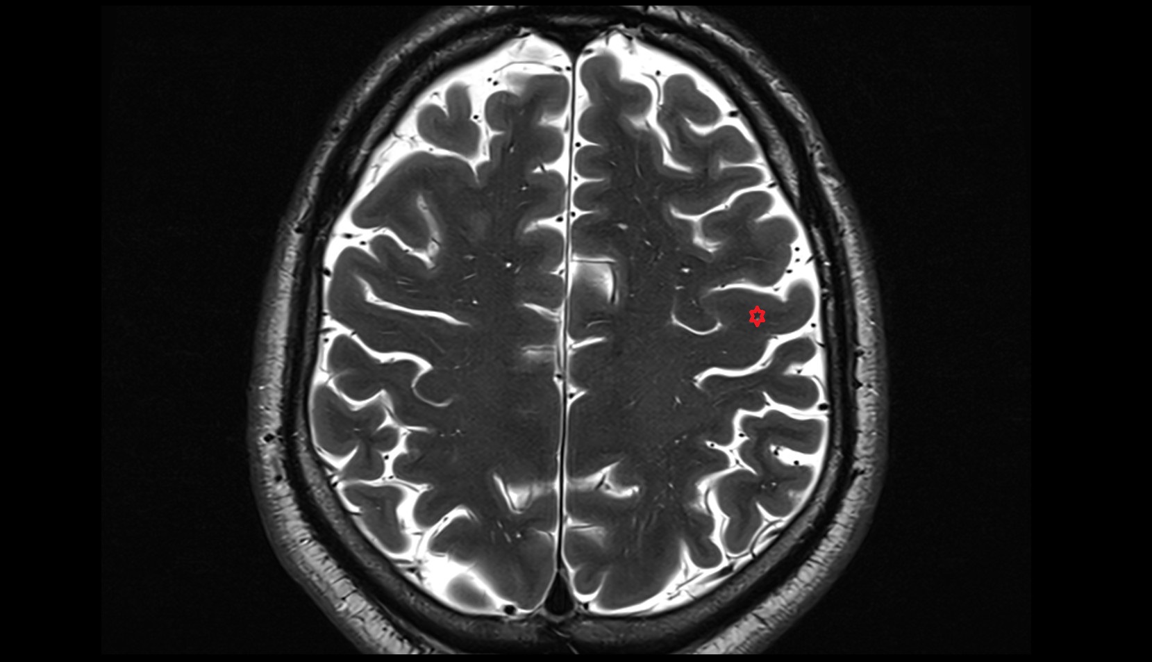 Precentral gyrus MRI 3T axial IMAGE