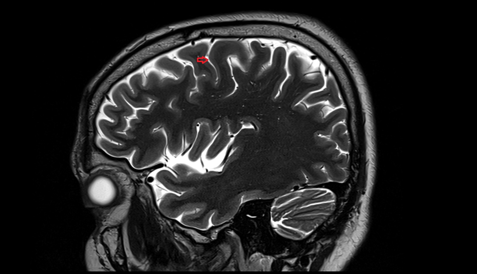 Precentral sulcus MRI 3T sagittal  image