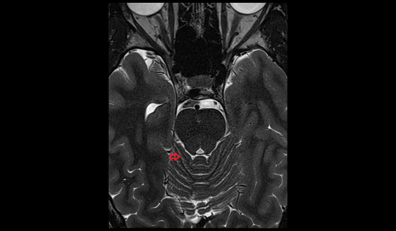 Preculminate fissure MRI 3T axial image