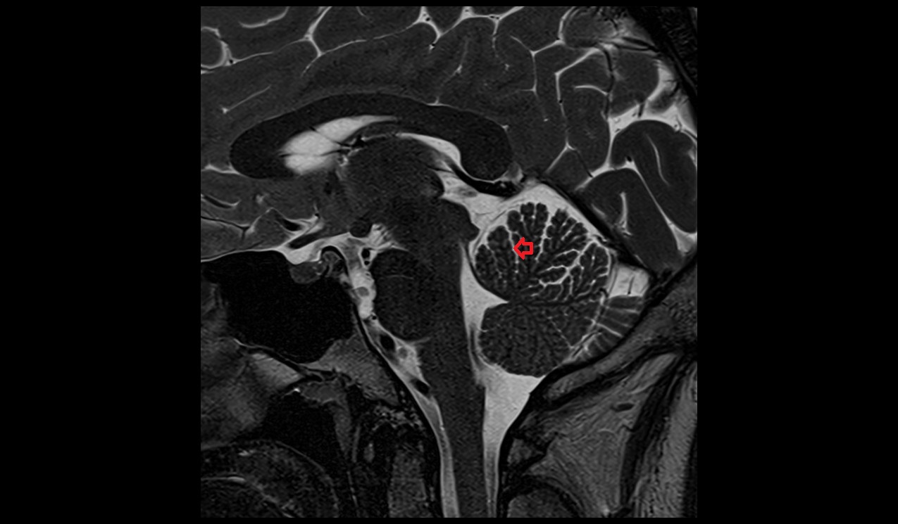 Preculminate fissure MRI 3T sagittal image