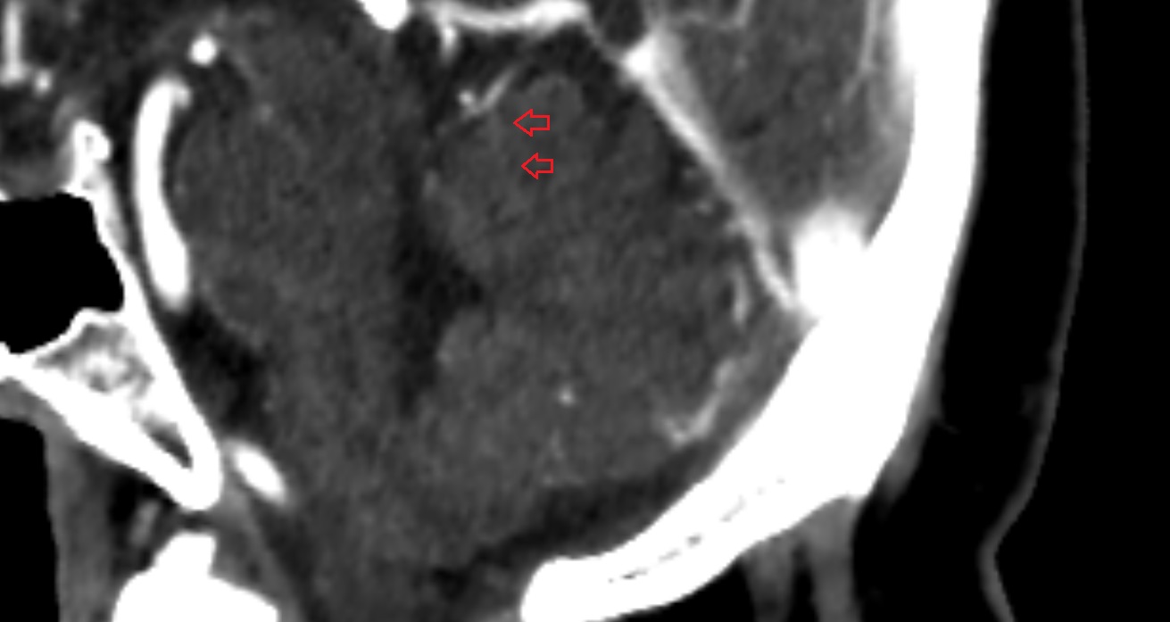 Preculminate fissure of cerebellum  CT sag  anatomy image -img-00001-00001