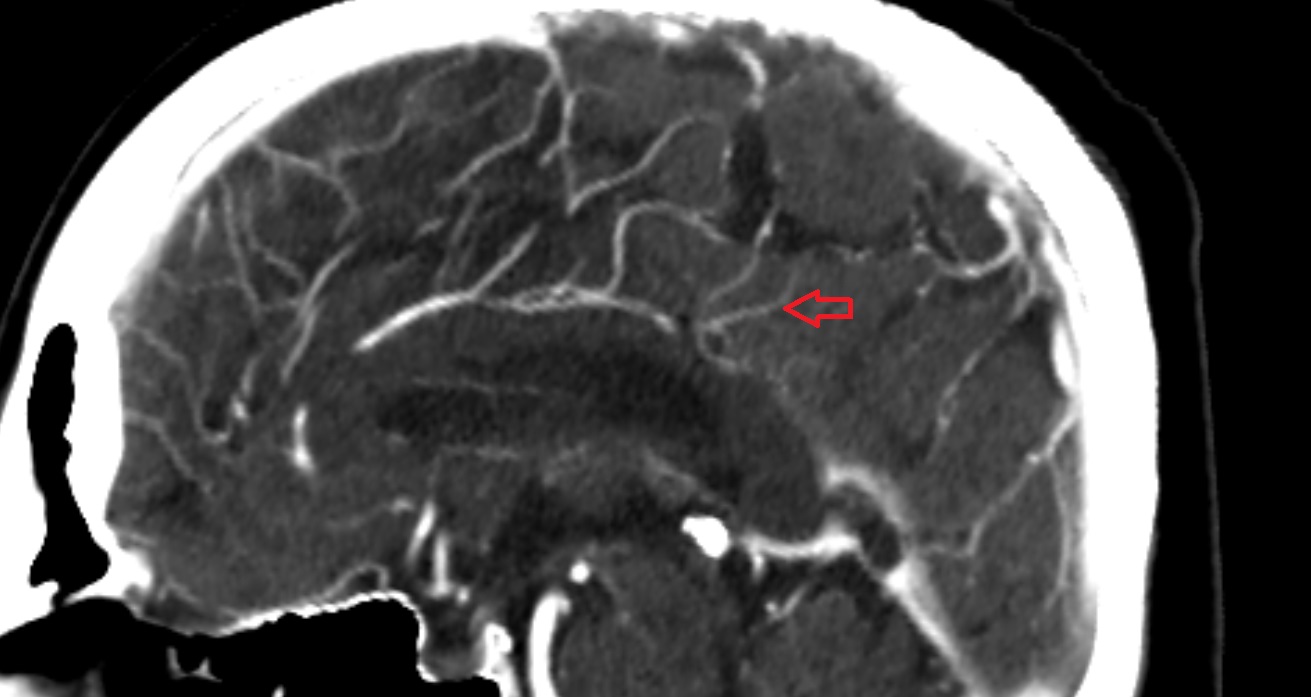 Precuneal artery  CT sagittal  anatomy image -img-00001-00001