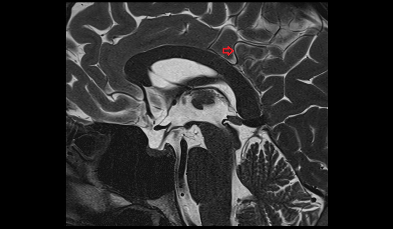 Precuneal artery MRI 3T sagittal image