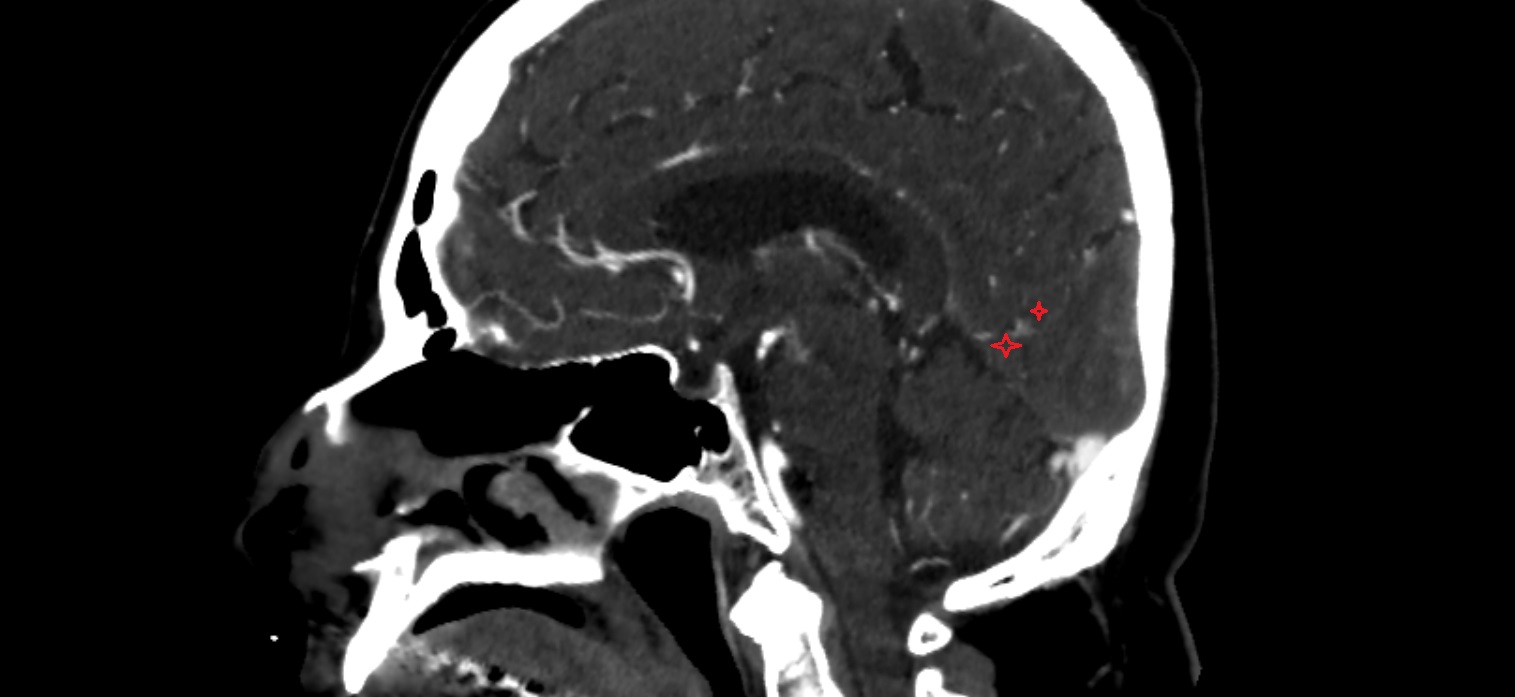 Precuneus  CT sag  cross sectional anatomy radiology image -img-00001-00001