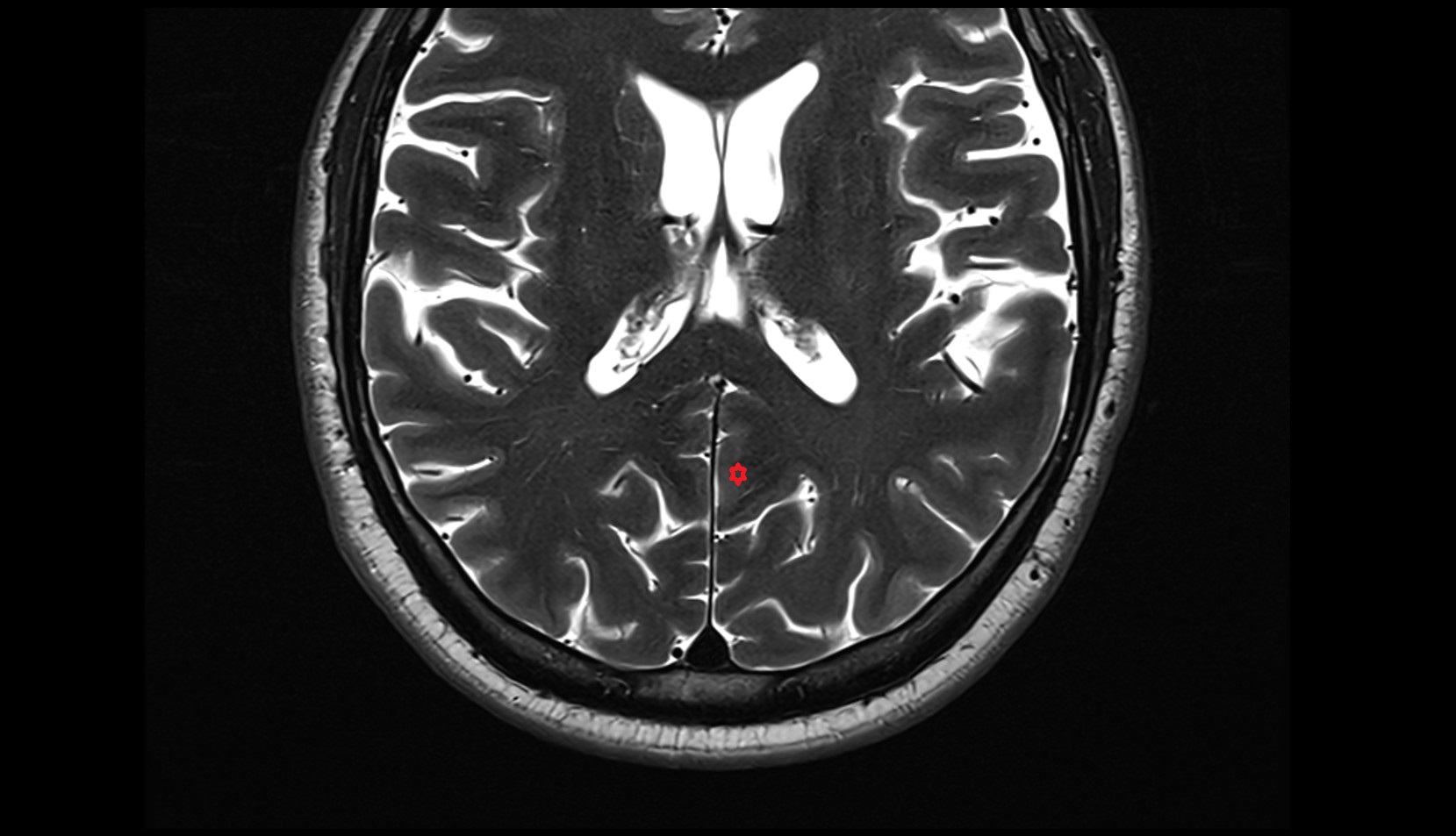 Precuneus mri 3t axial image