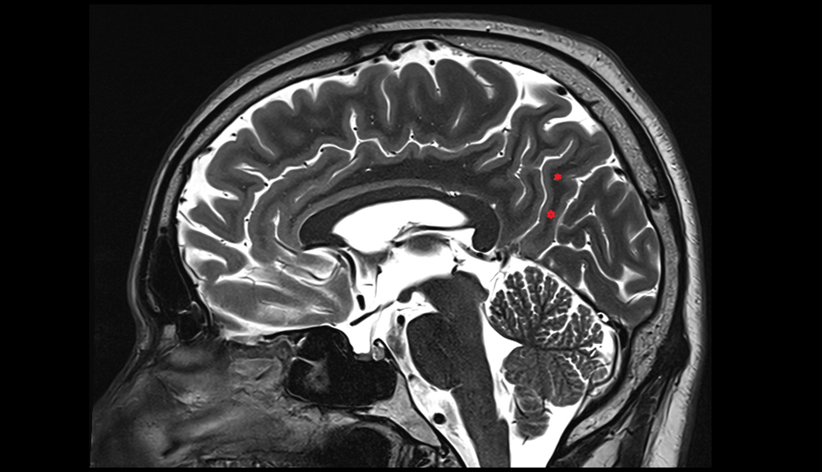 Precuneus mri 3t sagittal image